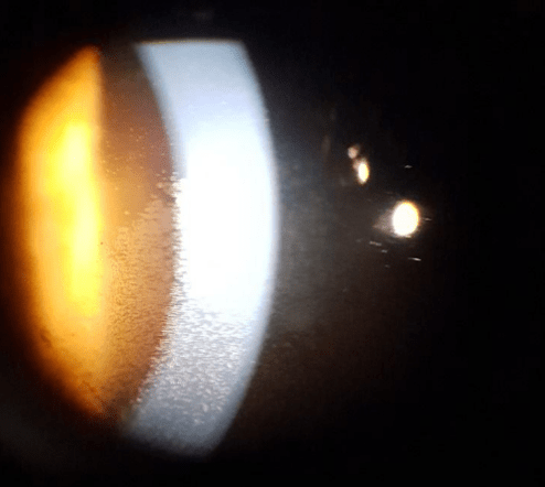 Slit lamp imaging