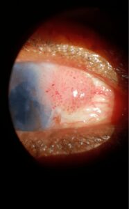 keratoconous