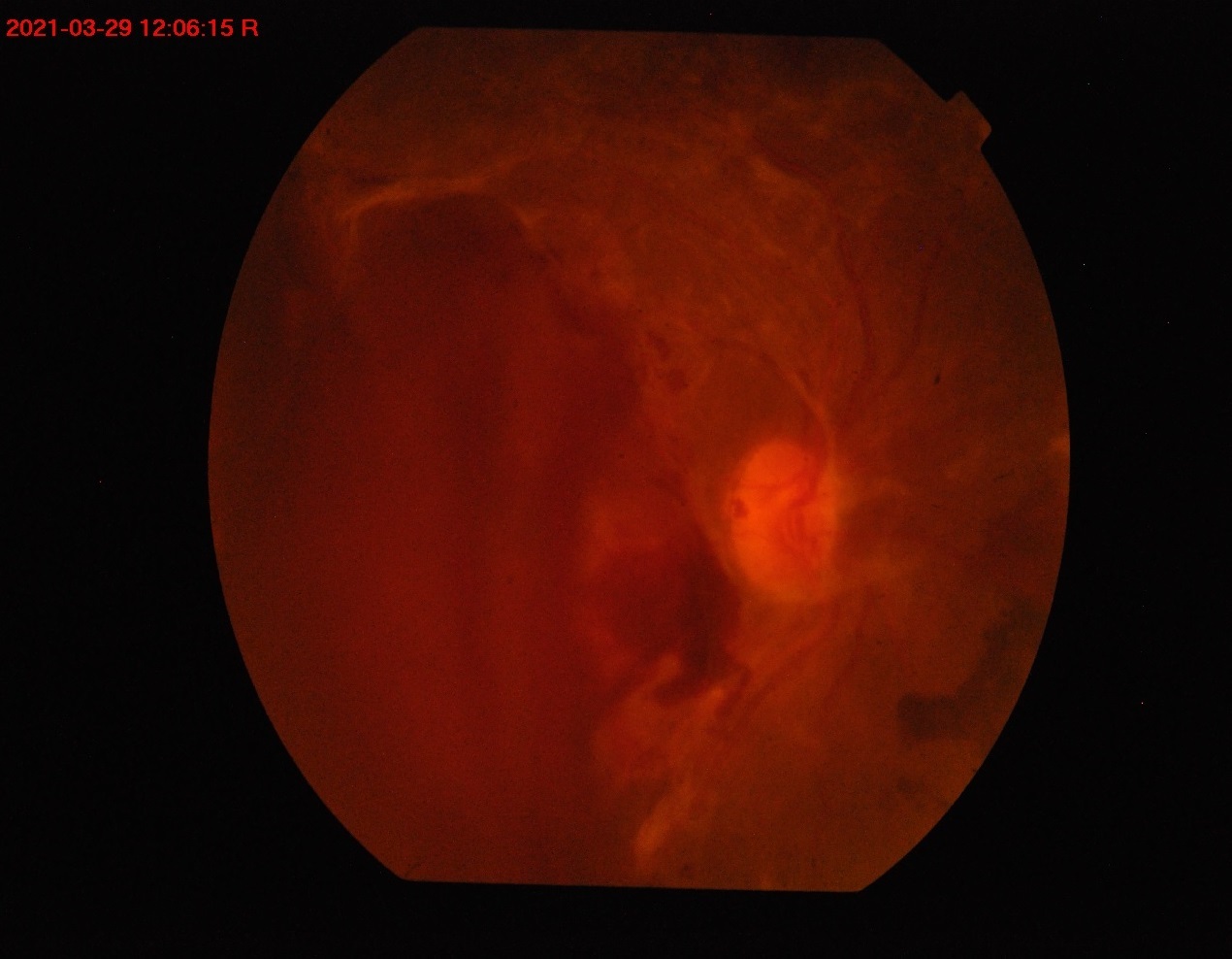 fundus retinal