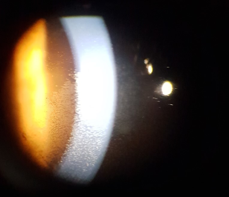 slit lamp imaging